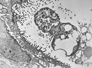 M,33y. | cryptosporidiosis - duodenum, im | munodeficient pacient